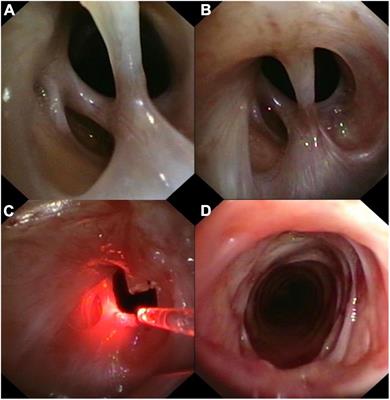 Case Report: Tracheal stenosis due to fibrotic bridges in a post-tracheostomy COVID-19 patient